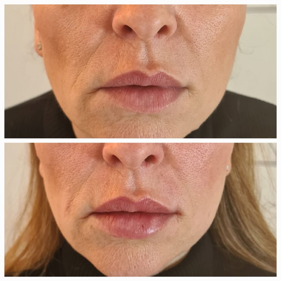 Viso maturo prima e dopo il trattamento full face