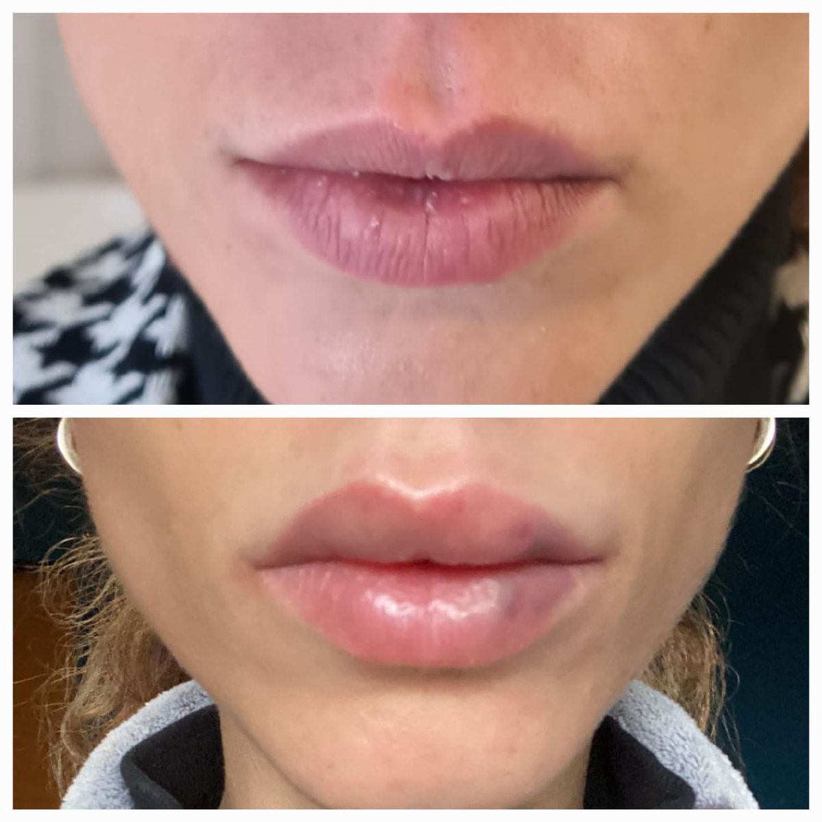 Labbra prima e dopo: proporzione e naturalezza