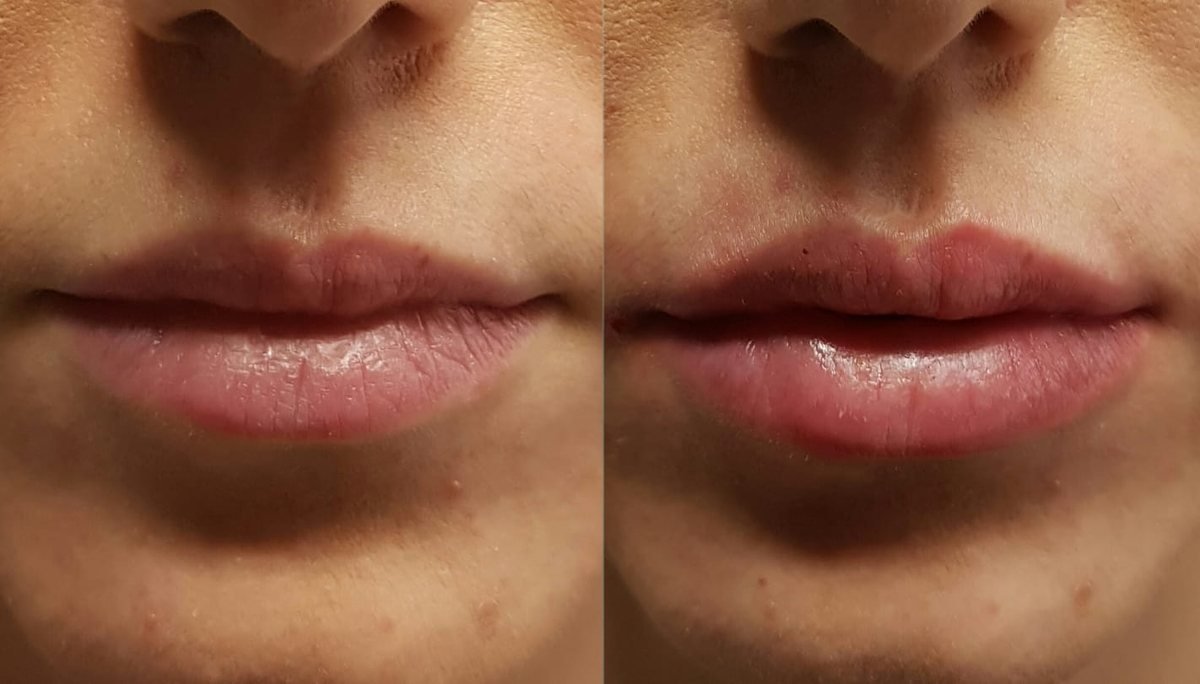Labbra prima e dopo: definizione del contorno