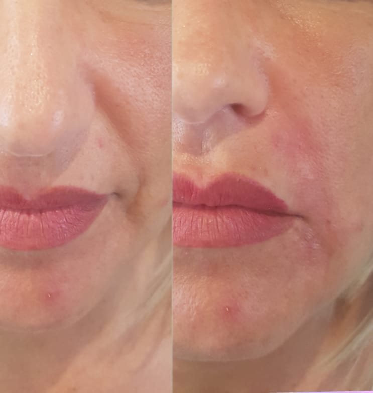 Guancia prima e dopo: qualit&agrave; della pelle